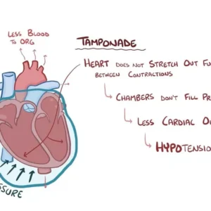 Cardiac Tamponade Ecg Findings