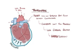 Cardiac Tamponade Ecg Findings