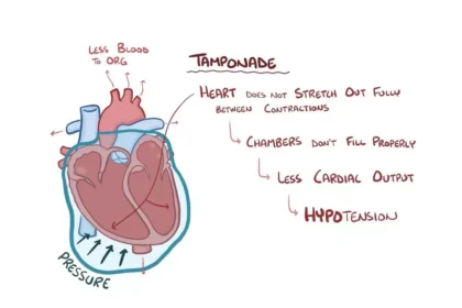 Cardiac Tamponade Ecg Findings