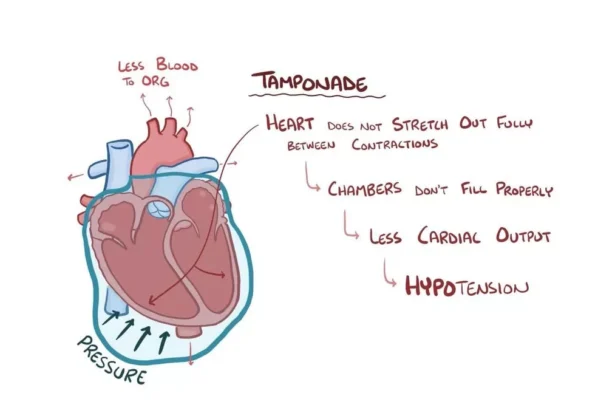 Cardiac Tamponade Ecg Findings Home Lady and Care