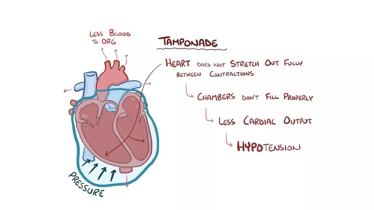 Cardiac tamponade ecg findings - Lady and Care