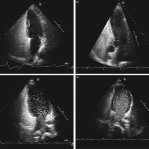 Echo Bubble Study Interpretation