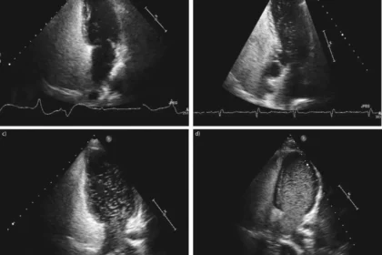 Echo Bubble Study Interpretation