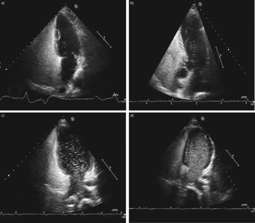 Echo Bubble Study Interpretation