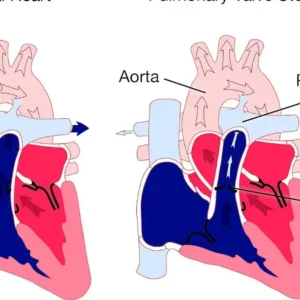 Aortic Stenosis Nursing Diagnosis