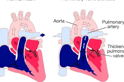 Aortic Stenosis Nursing Diagnosis