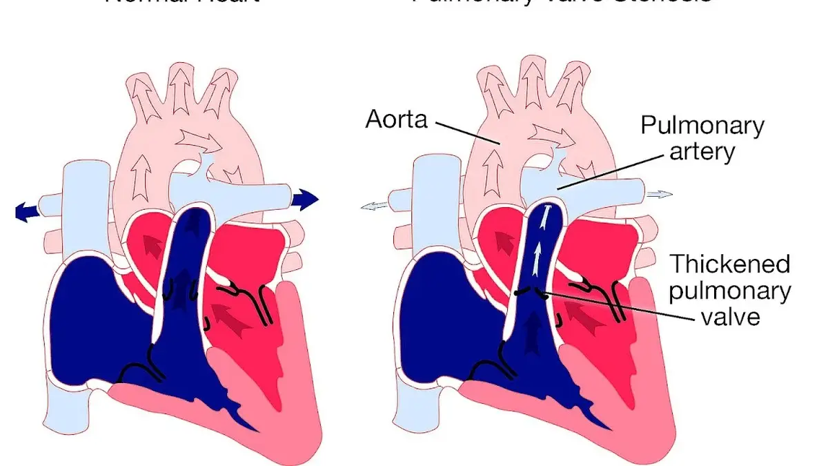 Aortic stenosis nursing diagnosis - Lady and Care