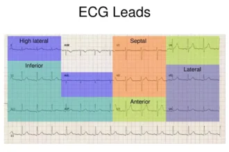 Ecg Leads Coronary Arteries