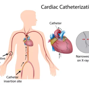 Groin Hematoma After Cardiac Catheterization