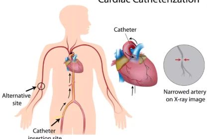 Groin Hematoma After Cardiac Catheterization