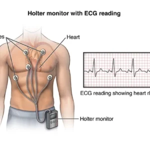 Holter Monitor Results Example