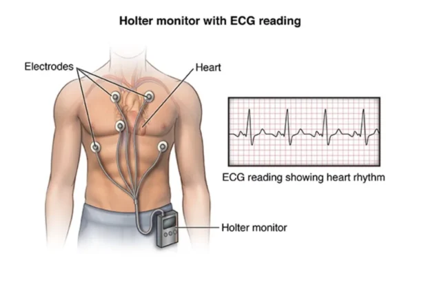 Holter Monitor Results Example Home Lady and Care
