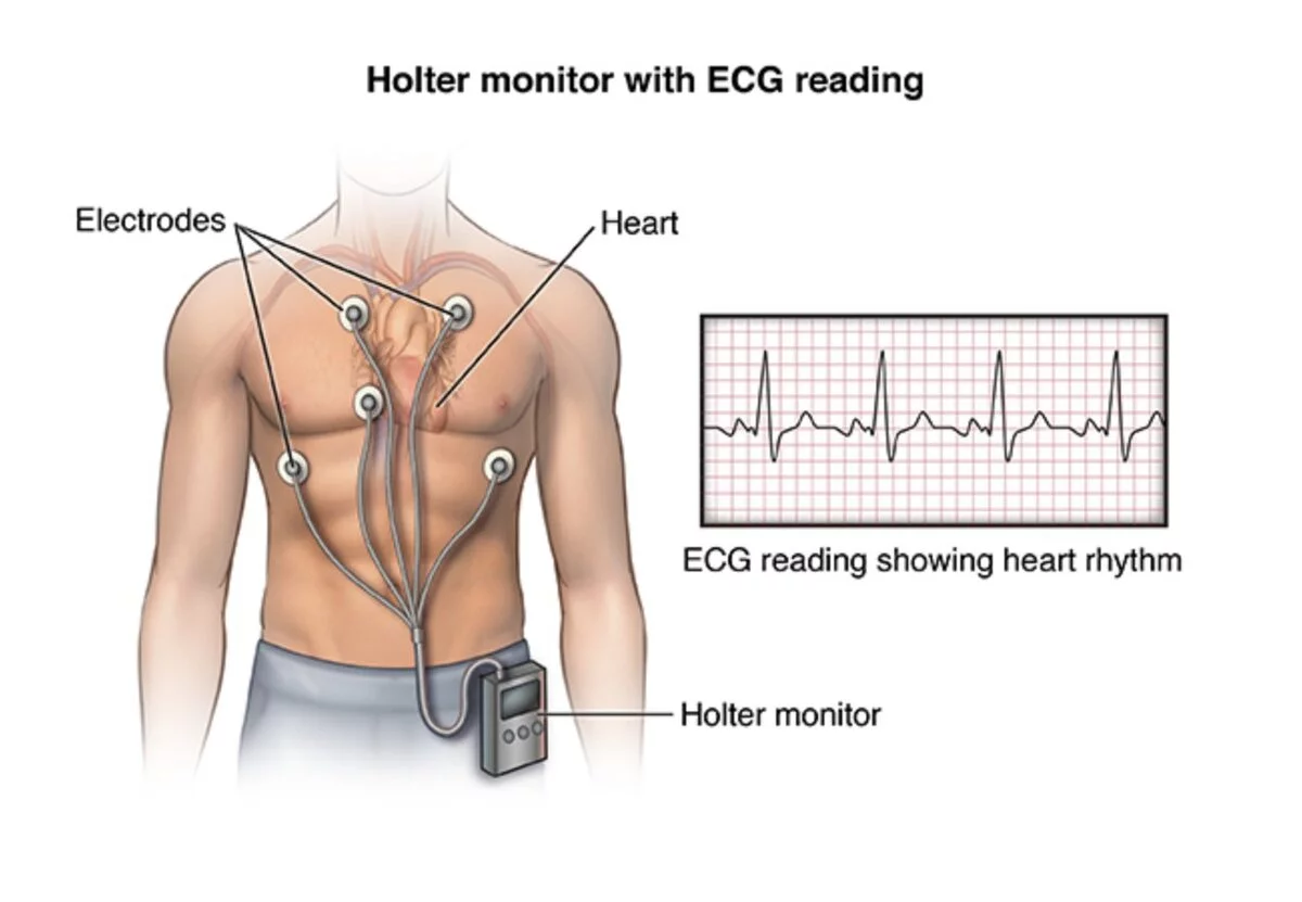 Holter Monitor Results Example