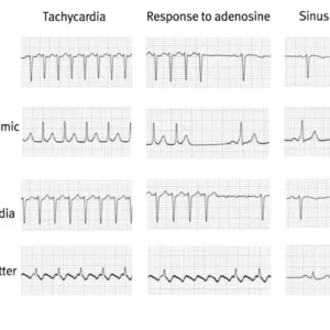Sinus Rhythm With Artifact
