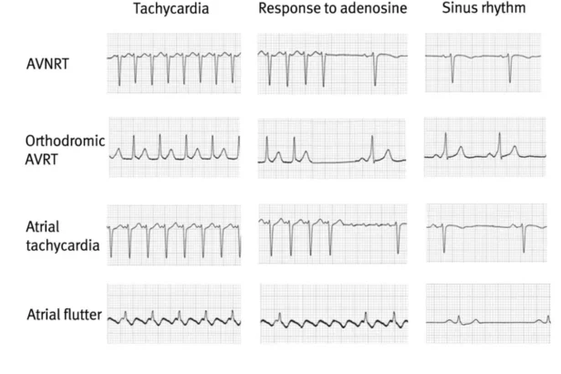 Sinus Rhythm With Artifact Home Lady and Care