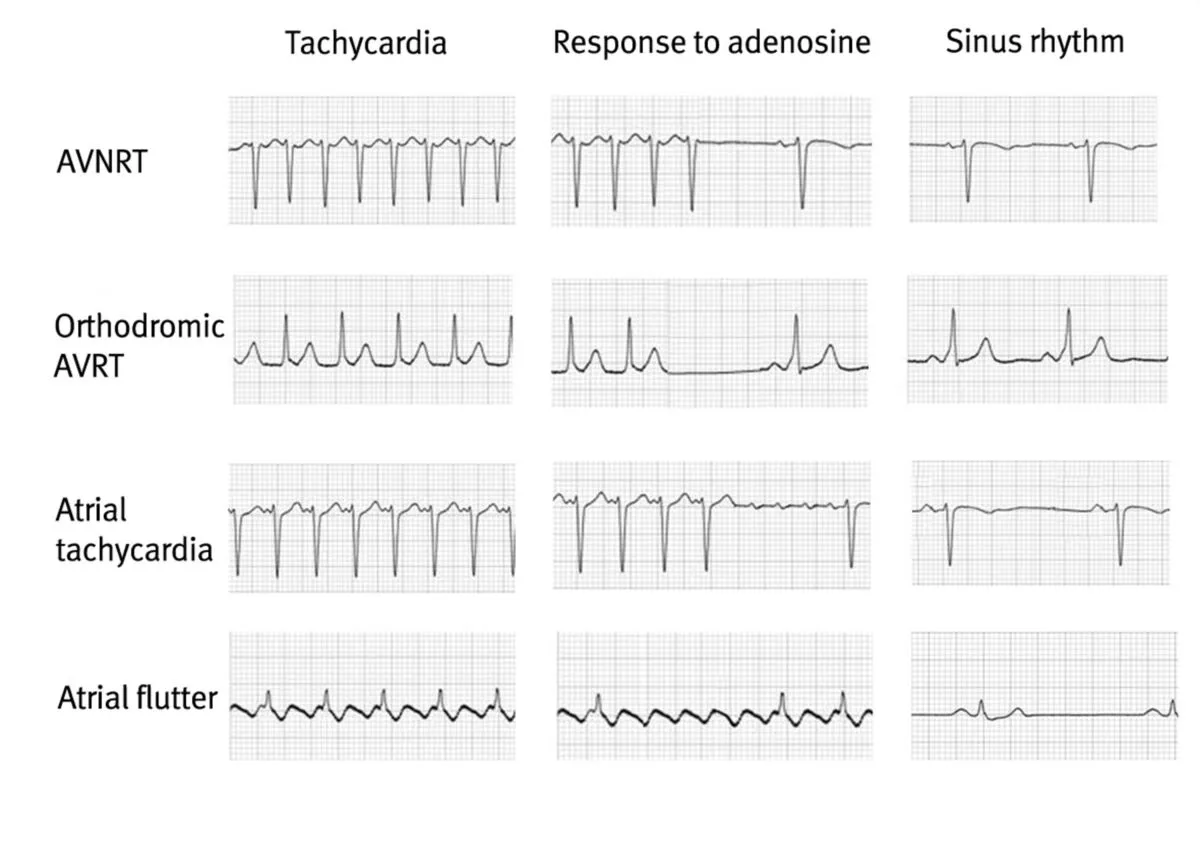 Sinus Rhythm With Artifact