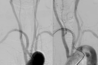 Nerve Damage After Radial Angiogram