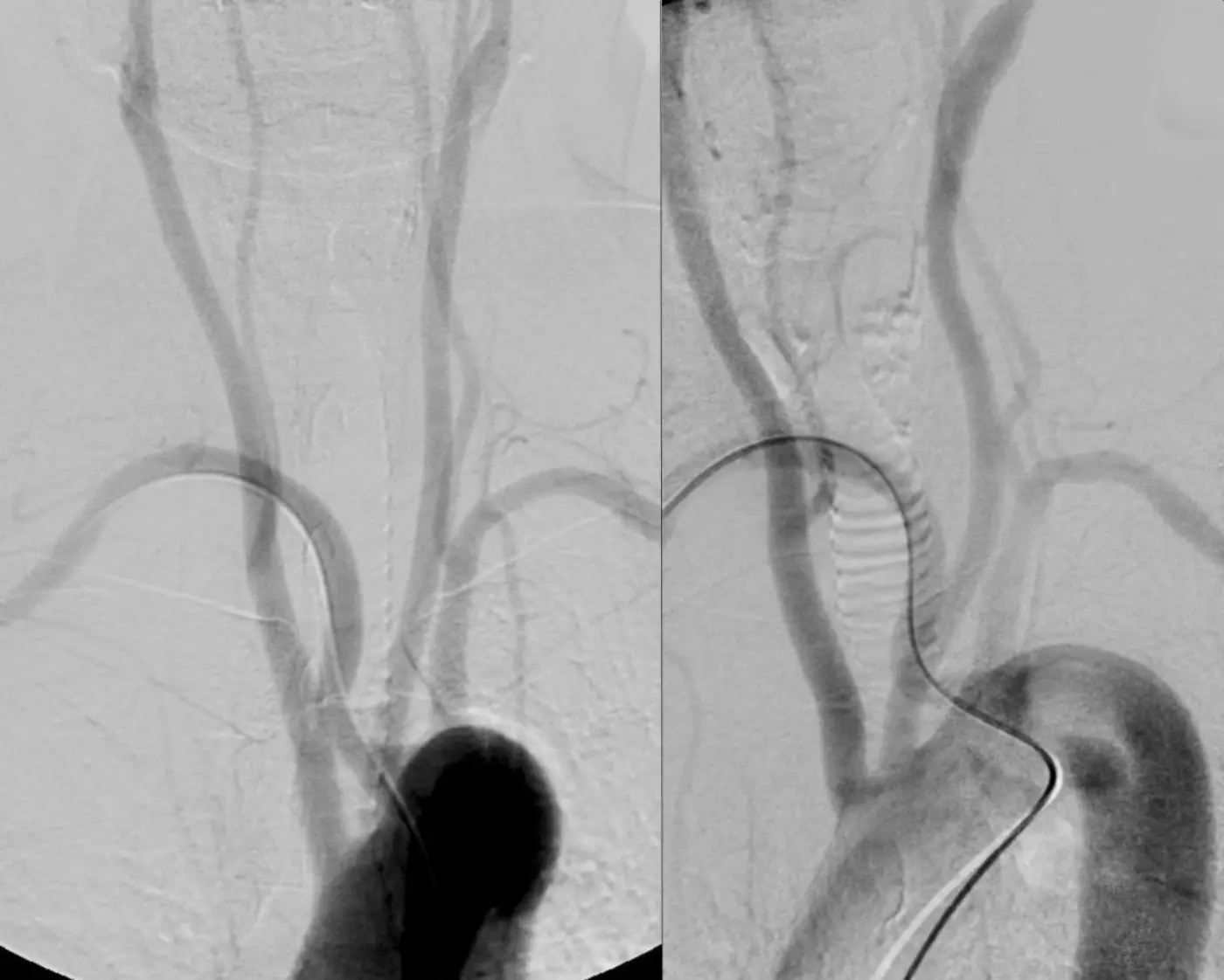 Nerve Damage After Radial Angiogram